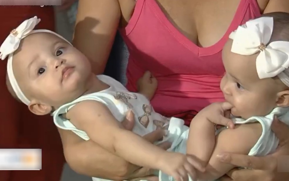 Gêmeas Laís e Laura nasceram unidades pelo abdome e bacia, em Piraí do Norte, Bahia — Foto: Reprodução/TV Anhanguera