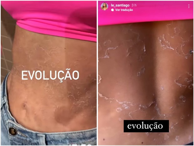 6 de junho de 2022: Letícia Santiago mostra evolução das manchas na barriga e nas costas (Foto: Reprodução/Instagram)