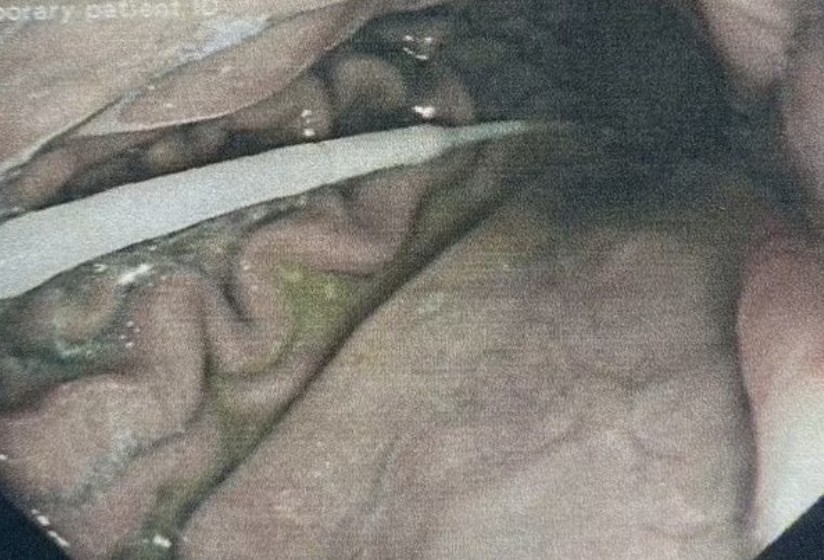 Usando uma câmera, os cirurgiões conseguiram remover o swab (Foto: Reprodução/Daily Mail)