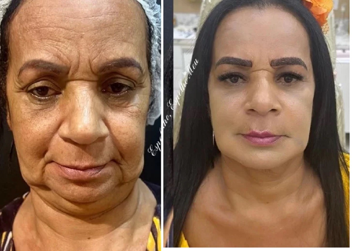 Antes e depois da harmonização facial da Gaguinha de Ilhéus — Foto: Reprodução/Instagram