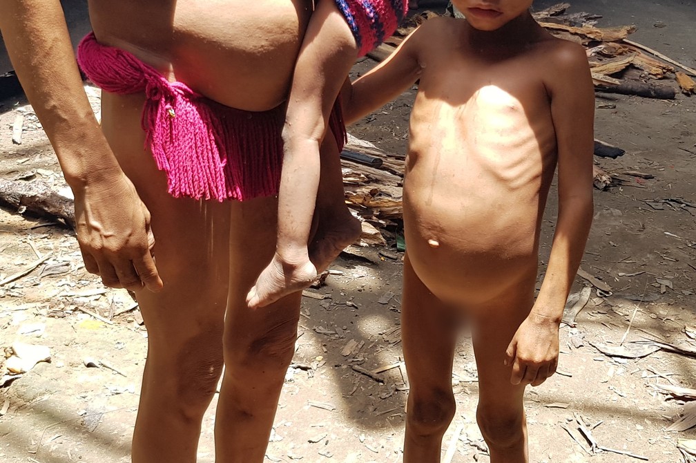 Menino Yanomami com costelas aparentes: 7 anos e 11 Kg; o ideal para a idade é 23 Kg, mais que o dobro — Foto: Valéria Oliveira/g1