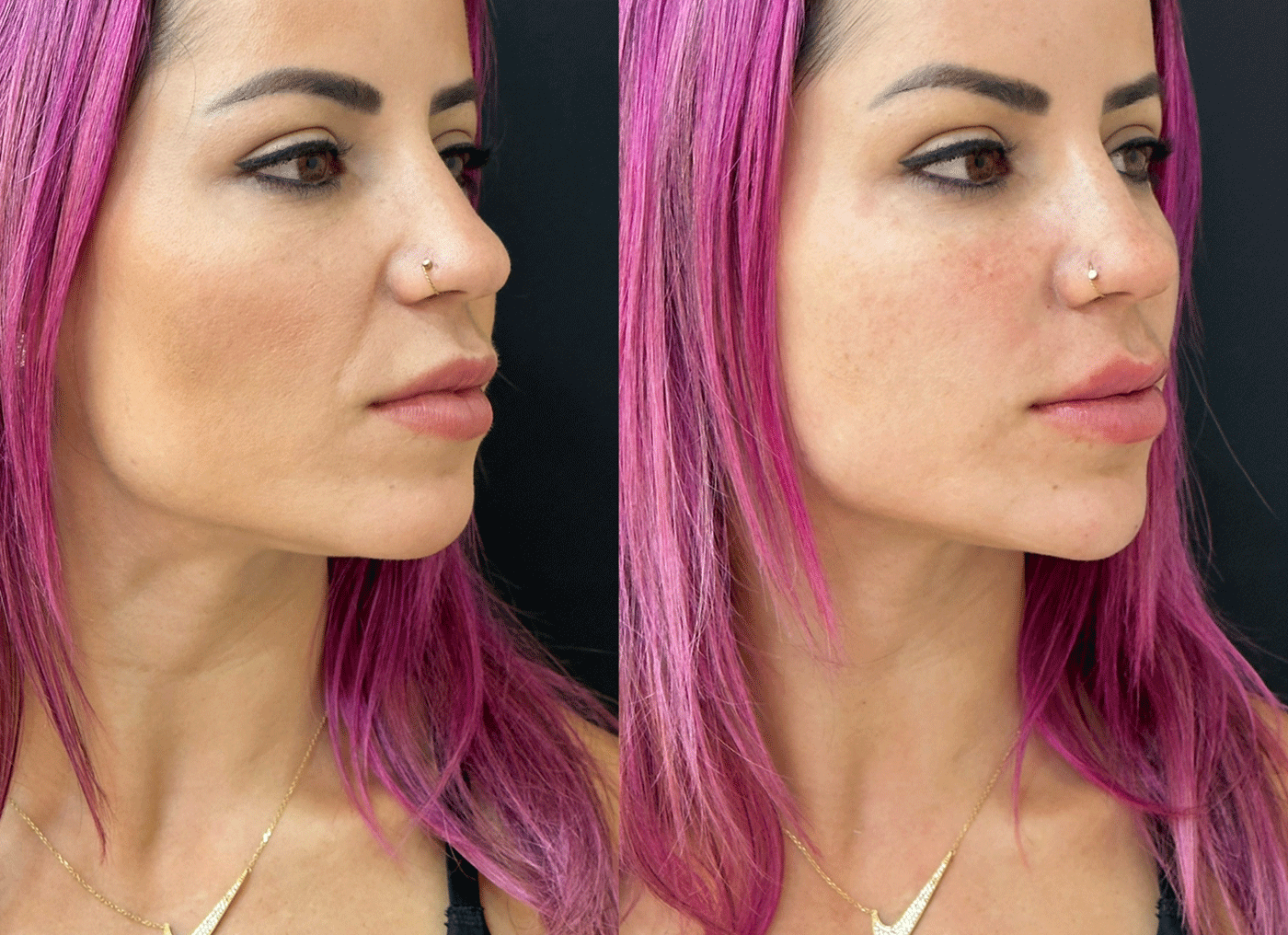 Leticia Bufoni antes e depois da harmonização facial — Foto: Divulgação