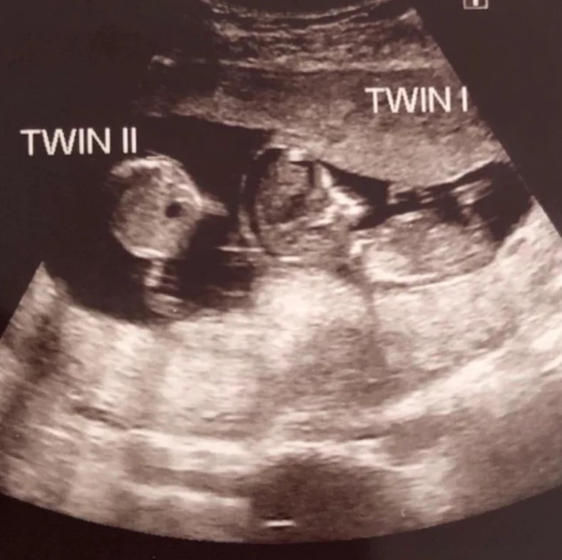 Mulher engravida enquanto já estava grávida e dá à luz gêmeos (Foto: Reprodução)