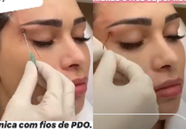 Flávia Pavanelli durante procedimento para ter foxy eyes (Foto: Reprodução/Instagram)