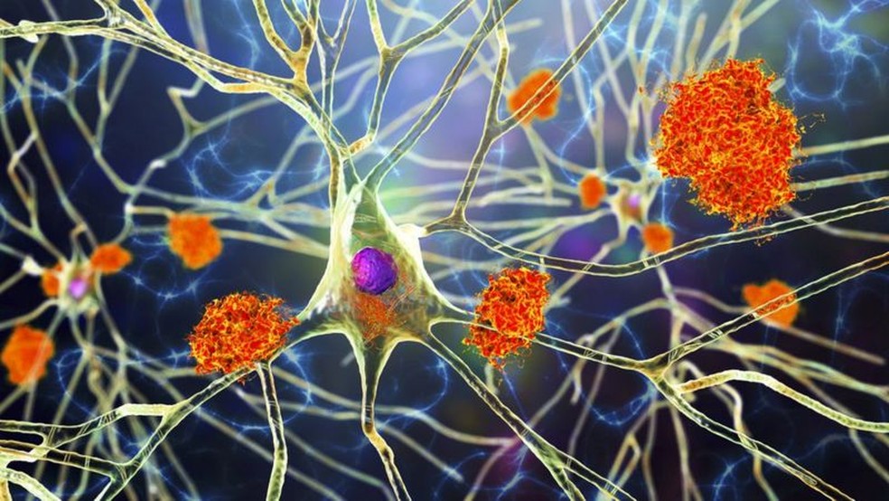 Os resíduos das células cerebrais incluem a chamada proteína beta-amilóide, que pode estar envolvida com a doença de Alzheimer — Foto: BBC