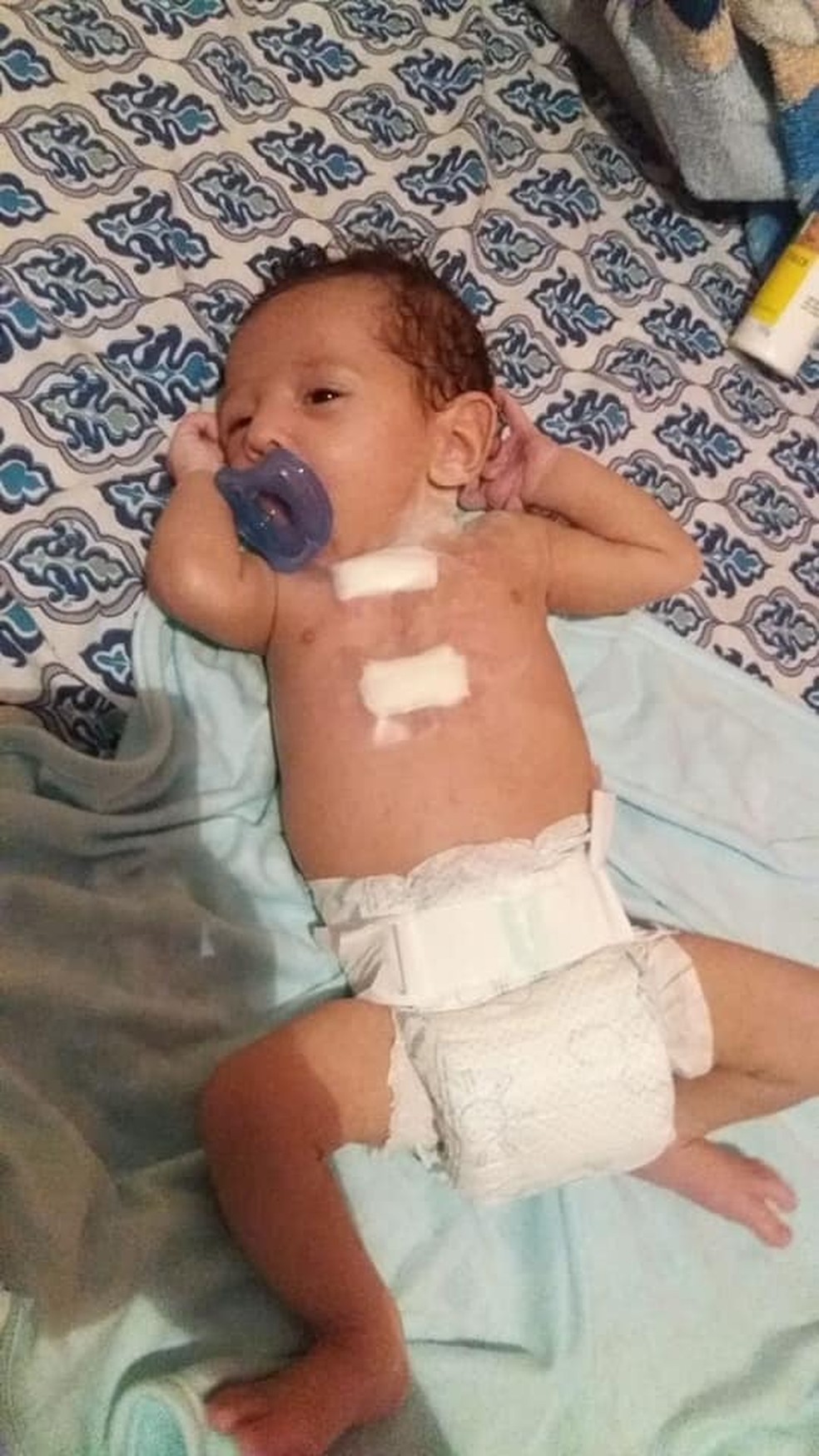 Cicatriz no peito lembra cirurgia de peito aberto realizada com menos de um ano de vida — Foto: Arquivo Pessoal