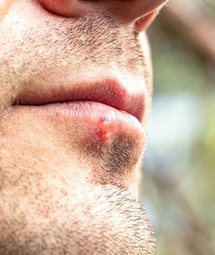 Variantes modernas da herpes têm ligação com beijos da Idade do Bronze