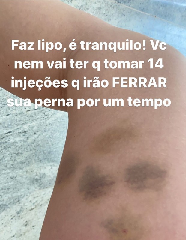 Virginia Fonseca mostra roxos após lipo (Foto: Reprodução/Instagram)