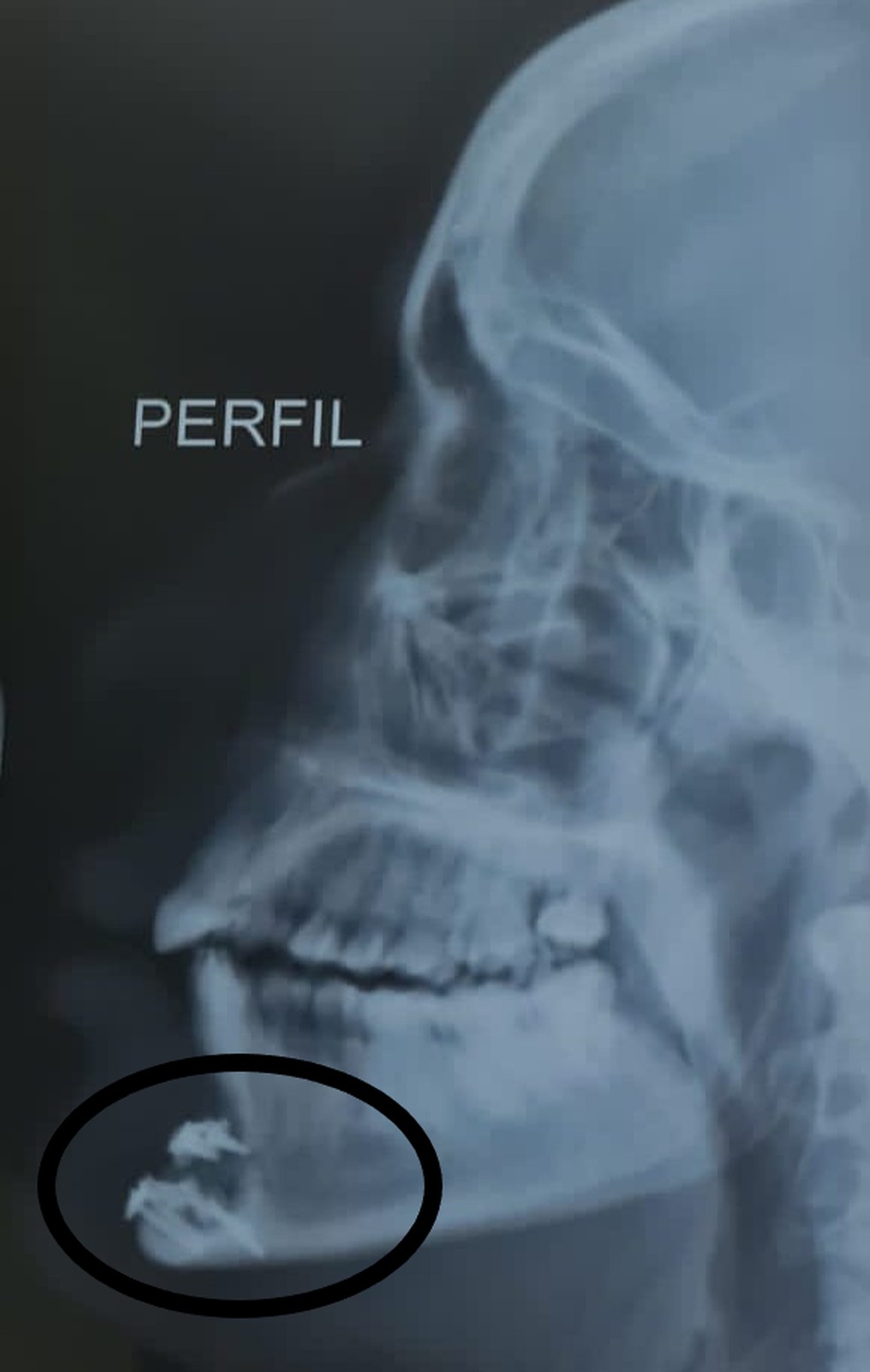 Ana Luiz e os pinos colocados na mandíbula que foi quebrada: dor e recuperação difícil — Foto: Arquivo pessoal