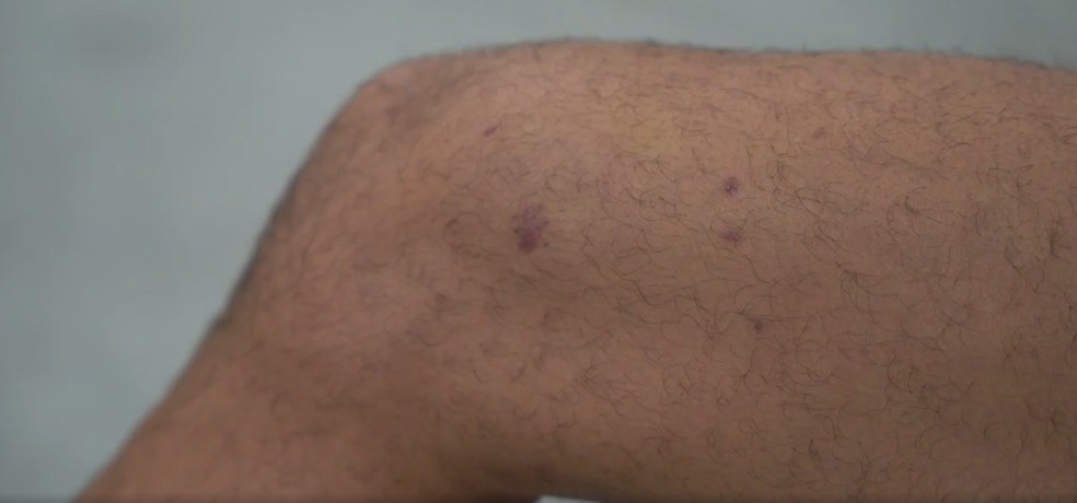 Danilo Fernandes mostra marcas de estilha&ccedil;os &mdash; Foto: EC Bahia / Reprodu&ccedil;&atilde;o