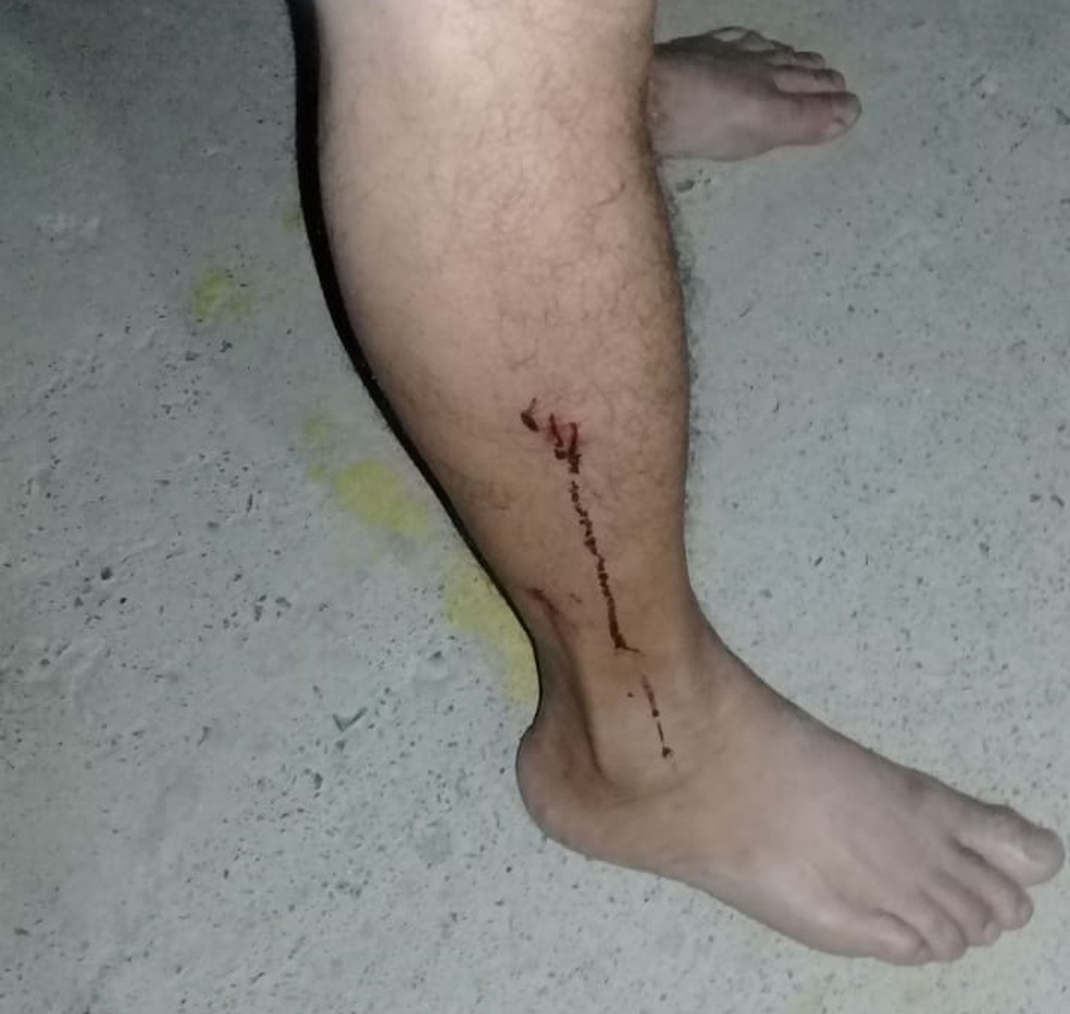 Homem ficou ferido na perna — Foto: João Lucas de Oliveira/ Arquivo pessoal