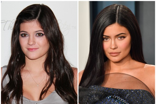 A socialite Kylie Jenner antes e depois de seu preenchimento labial (Foto: Getty Images)