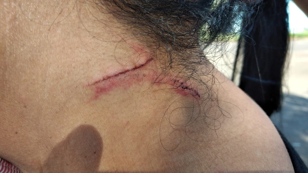 Ferimento na mulher que disse ter sido atacada pelo suspeito momentos antes do estupro — Foto: Eduardo de Almeida/TV Morena