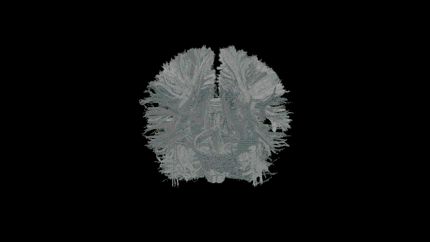 Imagens de tomografia cerebral (Foto: GE)