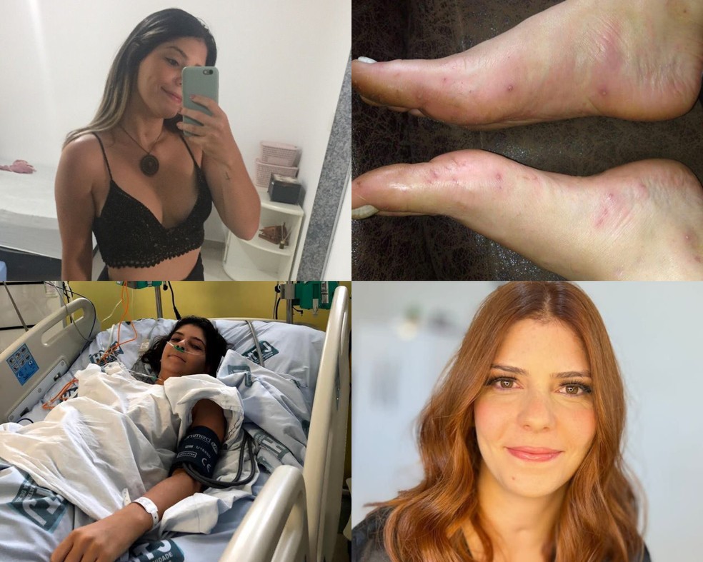 Gabriela Melo teve o pé amputado após contrair uma infecção gerada por espinhos ainda em 2017 — Foto: Gabriela Melo/Arquivo Pessoal