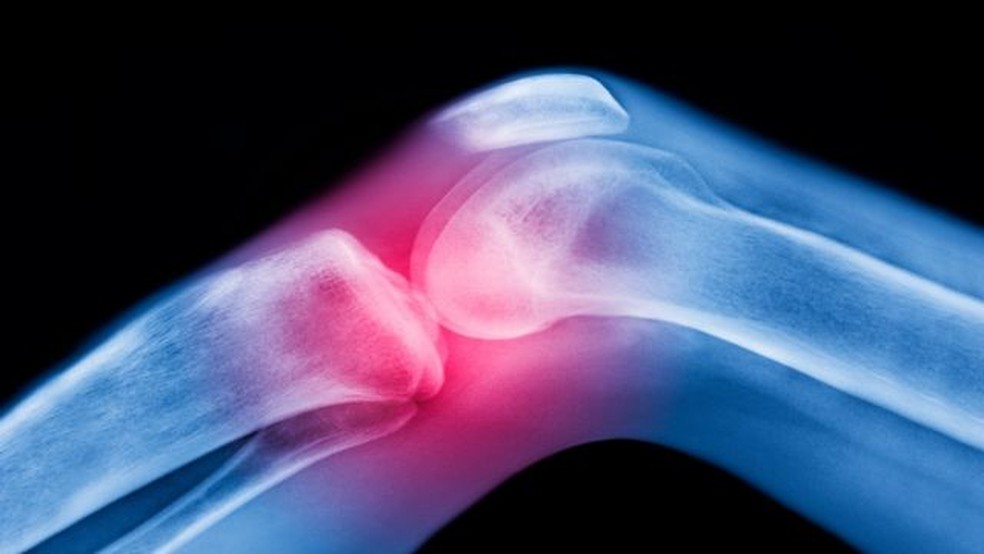 A deterioração da cartilagem causa dores — Foto: Getty Images via BBC