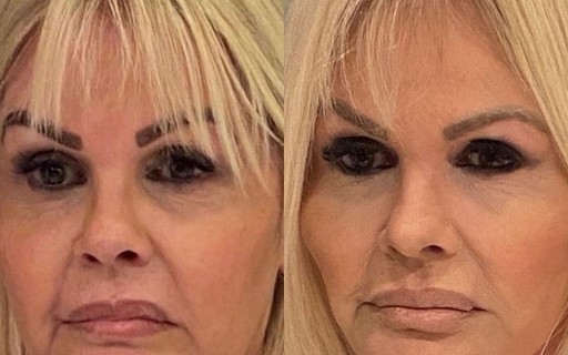 Monique Evans posta antes e depois de procedimento na face e intriga internautas