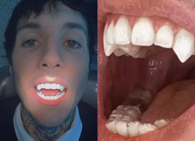 Oliver Sykes: vampiro via dentista (Foto: Reprodução Instagram)