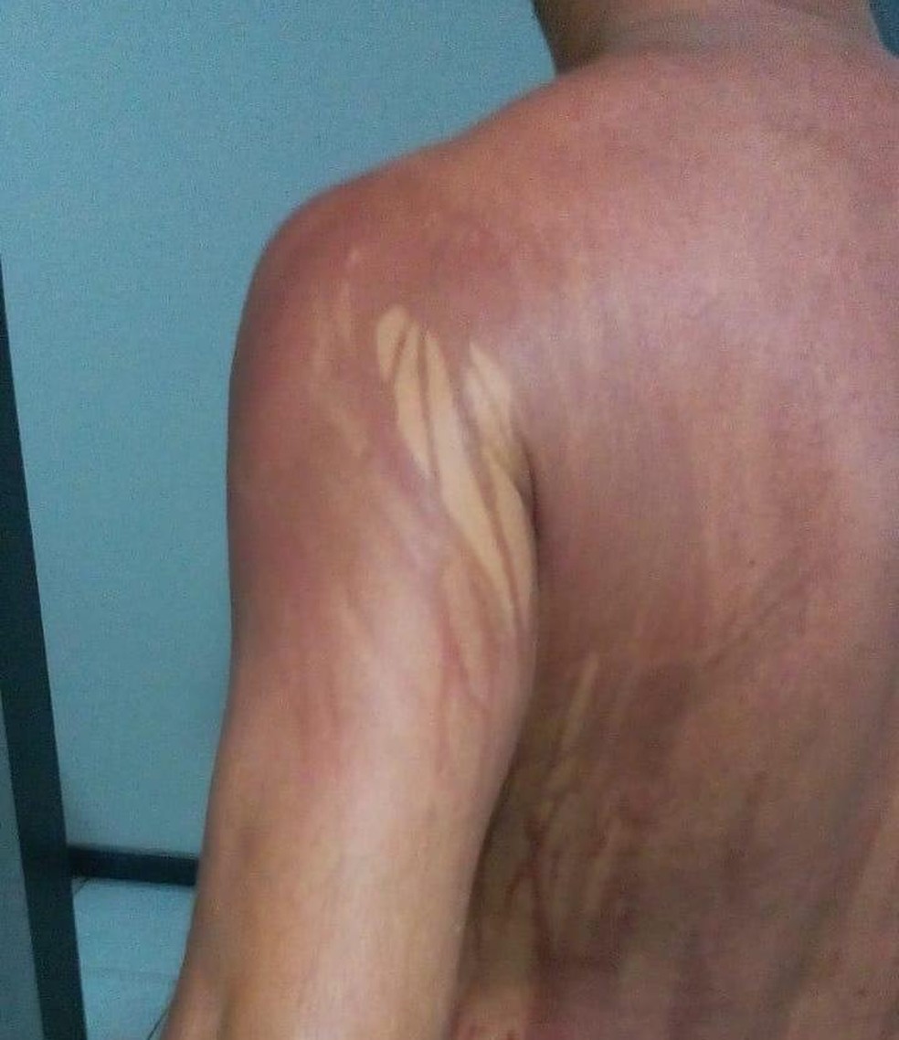 Turista de MG fica com manchas no corpo após banho de mar no sul da Bahia — Foto: Arquivo Pessoal