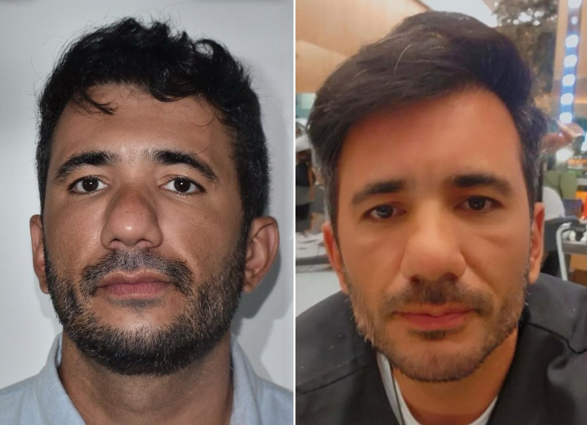 Vitor Vianna antes e depois da harmonização facial (Foto: Divulgação)