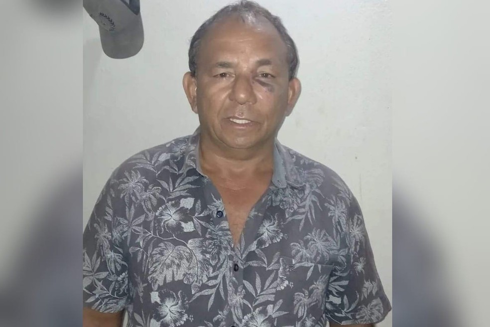 Vereador de Tamboril mostra rosto inchado após agressão, no Ceará. — Foto: Arquivo pessoal/Reprodução