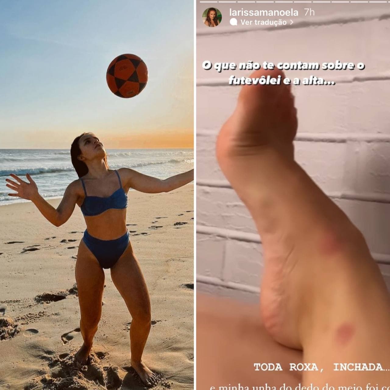 Larissa Manoela usa as redes para mostrar pé machucado após jogar futevôlei e altinha (Foto: Reprodução / Instagram)