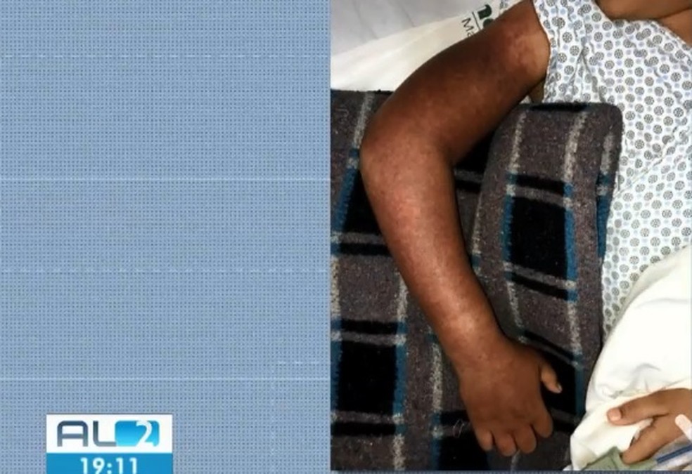 Menino de 10 anos tem braço sugado por ralo de piscina em Maceió — Foto: Reprodução/TV Gazeta