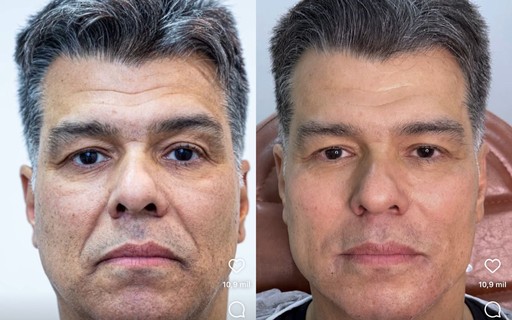 Maurício Mattar passa por harmonização facial; veja antes e depois