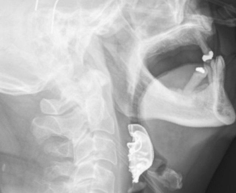 A obstrução na garganta causou dificuldades para o homem comer, respirar e dormir — Foto: Divulgação/BMJ Case Reports 2019