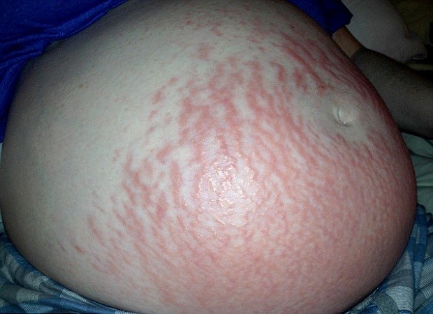 Reação alérgica na barriga de Fiona (Foto: Reprodução)