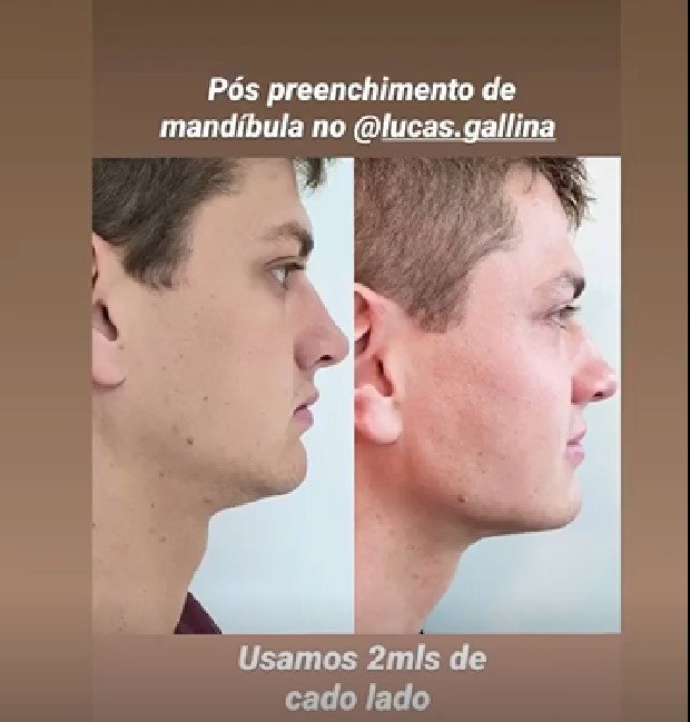 Lucas Gallina mostra antes e depois de preenchimento da mandíbula (Foto: Reprodução/Instagram)