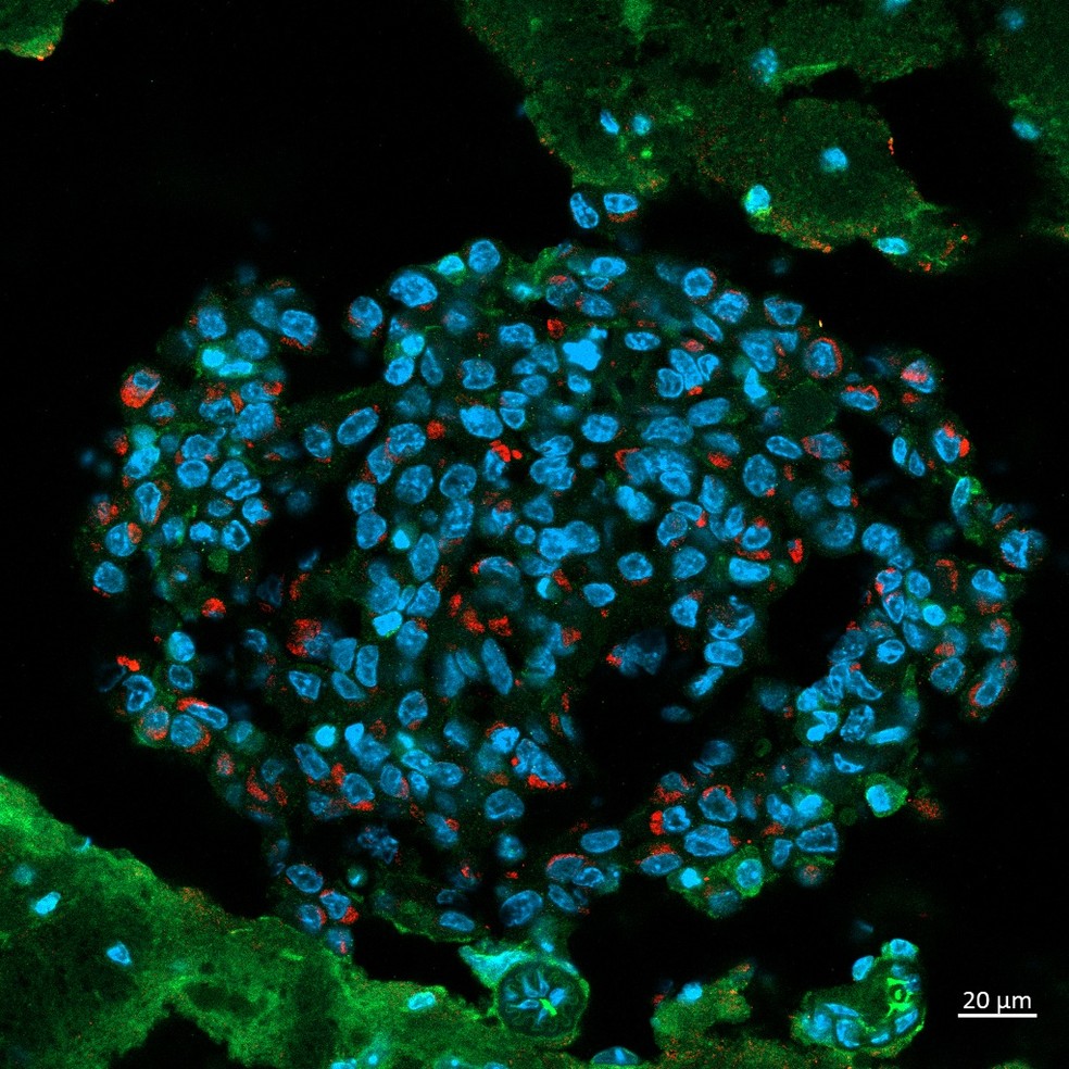 A imagem mostra o tumor no cérebro do camundongo. Cada ponto azul é o núcleo de uma célula tumoral. As partes verdes representam o cérebro do animal. Já as manchas vermelhas, são o vírus da zika dentro do tumor (Foto: Núcleo de Divulgação Científica da USP)