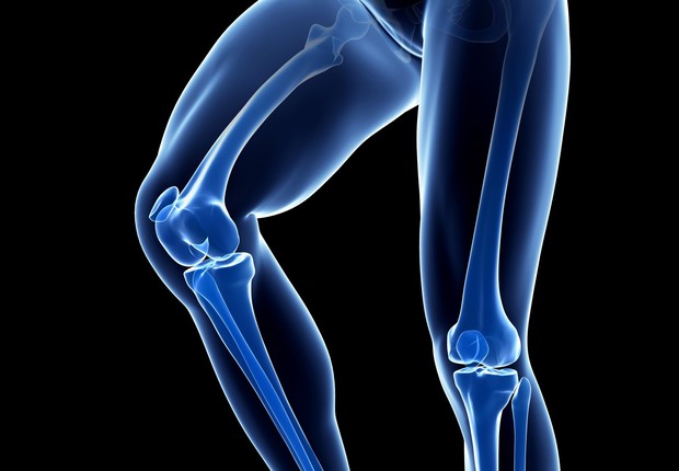 No procedimento, ossos do fêmur são quebrados e recebem pregos que estendem os ossos lentamente durante três meses (Foto: Getty Images)