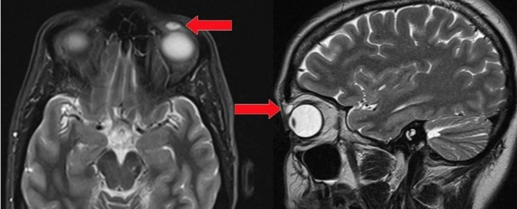 Ressonância magnética constatou a presença de um objeto no olho de paciente (Foto: Divulgação)