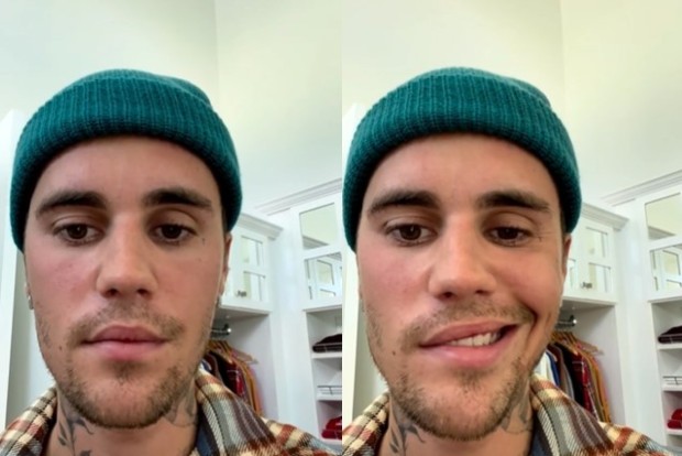 Justin Bieber informa aos fãs que foi diagnosticado com a síndrome de Ramsay Hunt e mostra rosto paralisado (Foto: Reprodução/Instagram)
