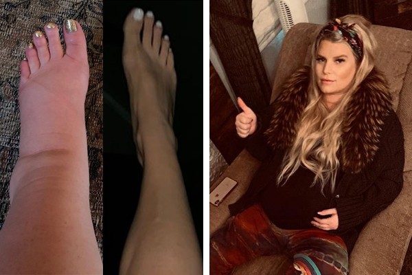 Jessica Simpson mostrou aos seus seguidores no Instagram como seu tornozelo ficou inchado durante a gravidez (Foto: reprodução / Instagram)