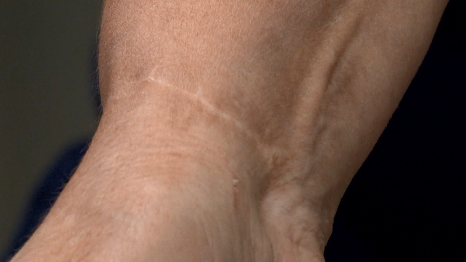 Tatuadores voluntários cobrem cicatrizes de mulheres vítimas de violência no ES