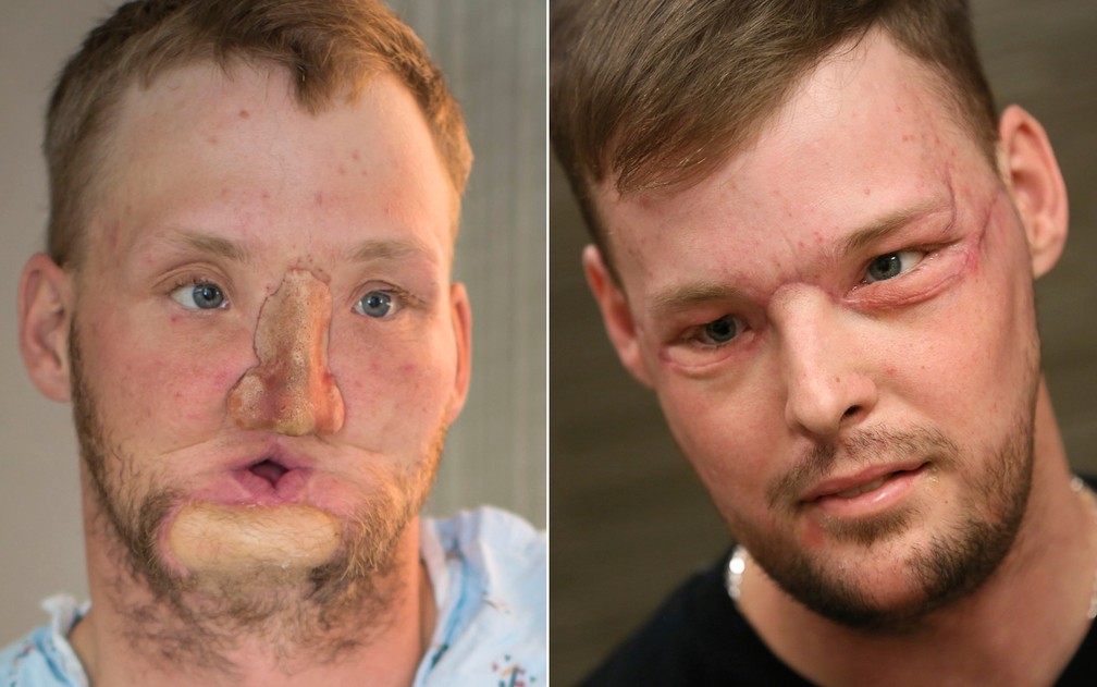 Foto de Andy de antes de sua cirurgia de transplante de face, em junho de 2016, e foto atual, de janeiro de 2017 (Foto: Eric M. Sheahan/Mayo Clinic via AP e AP Photo/Charlie Neibergall)