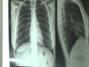 Doença pode ser diagnóstica pelo raio-x (Foto: Reprodução/TV Tapajós)