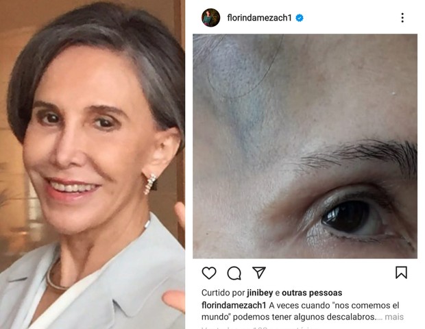 Florinda Meza, do 'Chaves', exibe hematoma em rosto após queda (Foto: Arquivo pessoal)