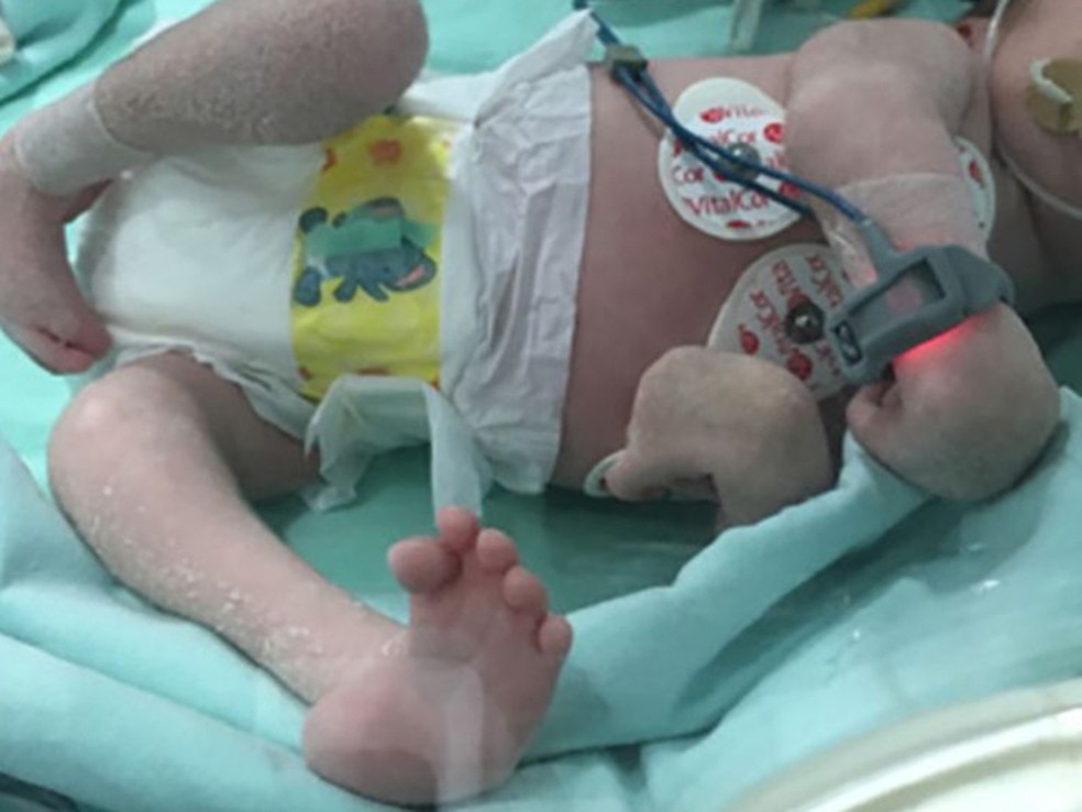 Atrav&eacute;s das diretrizes, Pernambuco busca facilitar as investiga&ccedil;&otilde;es posteriores sobre os casos de s&iacute;ndrome cong&ecirc;nita de zika (Foto: Reprodu&ccedil;&atilde;o/British Medical Journal)