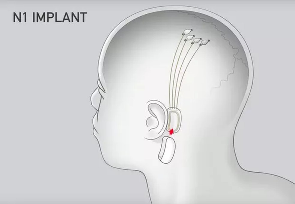 Um dos modelos do implante cerebral da Neuralink — Foto: Neuralink/Divulgação