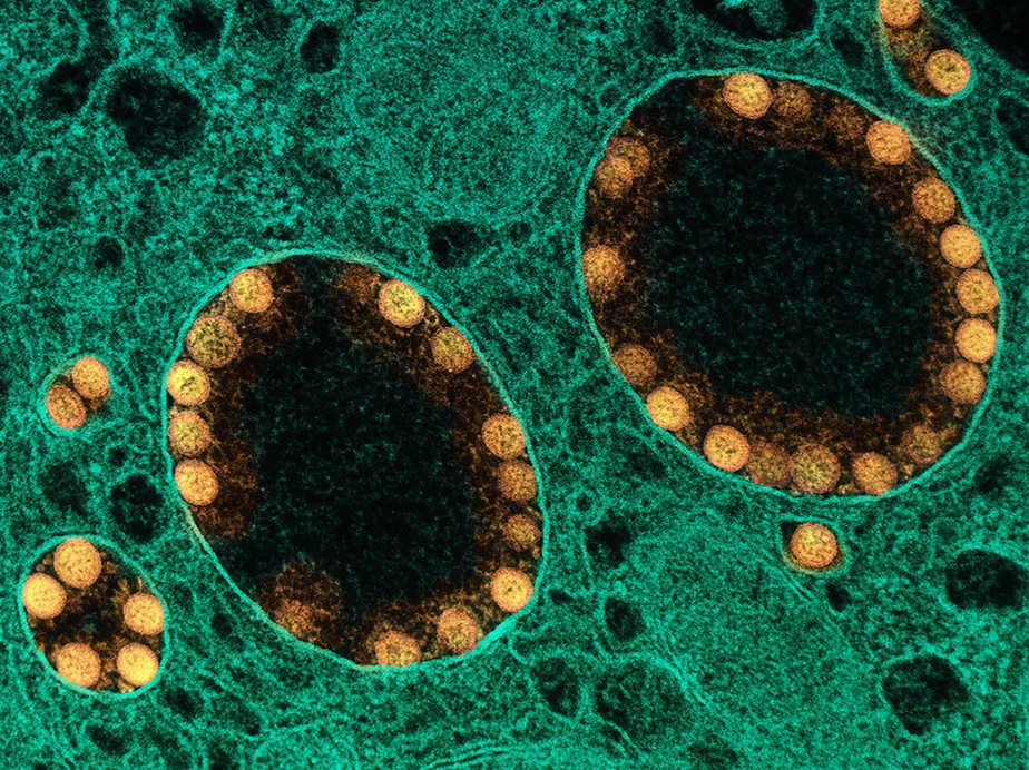 Imagem de microscópio que mostra partículas do coronavírus (dourado) dentro células do nariz de uma pessoa infectada.