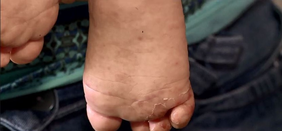 Doença 'mão-pé-boca' causa manchas vermelhas nos pés, boca e mãos — Foto: Reprodução/NSC TV