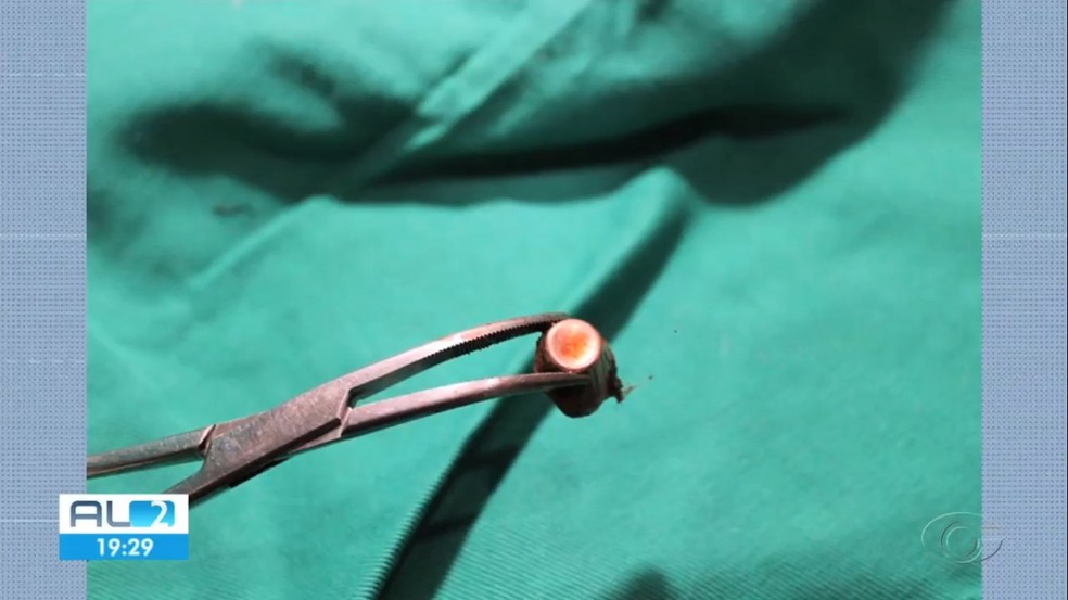 Projétil retirado de corpo de cadela baleada no bairro Vergel do Lago, em Maceió — Foto: Reprodução/TV Gazeta