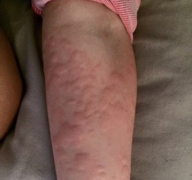 Apenas uma perna ou braço descobertos e a alergia já ataca (Foto: Reprodução/ Daily Mail)