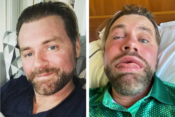 O cantor Brian McFadden antes e depois da picada de abelha (Foto: Reprodução/Instagram)