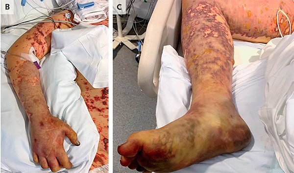 Braço e perna de jovem que sofreu sepse após se alimentar de restos de comida chinesa (Foto: divulgação/The New England Journal of Medicine)