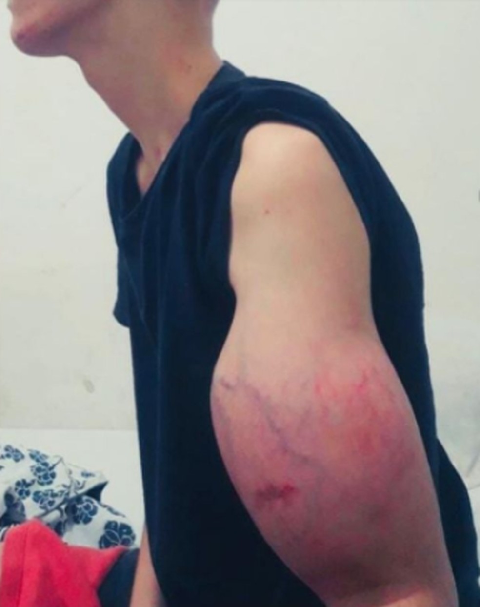 Adolescente amputará o braço direito na próxima semana, após iniciar tratamento contra um osteosarcoma — Foto: Arquivo Pessoal