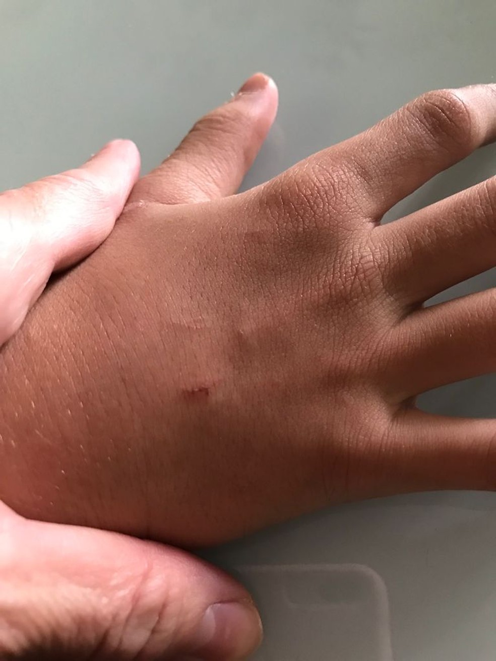Mão do menino também ficou machucada após ser agredido por psicóloga — Foto: Arquivo Pessoal